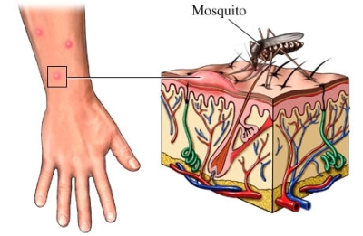 Mosquito Bite