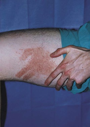 contact dermatitis wrist